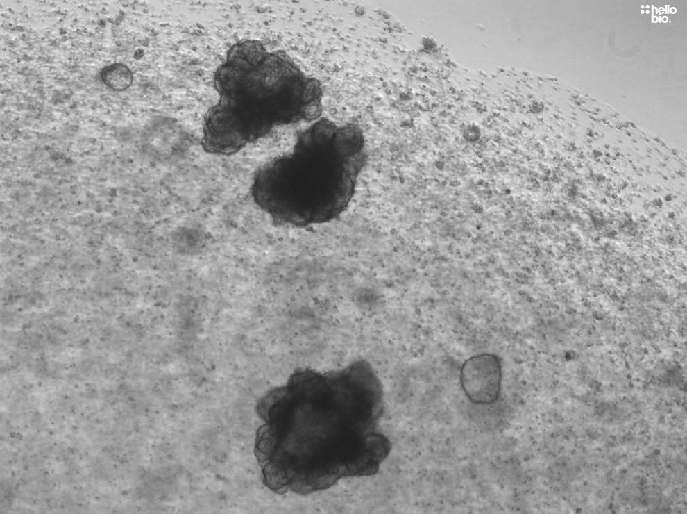 Figure. 2 Liver hepatocellular carcinoma tumouroids cultured with A83-01 (HB3218) and Forskolin (HB1348)